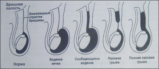 Водянка яичка при грыже