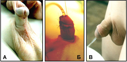 Отеки гипоспадия после операции