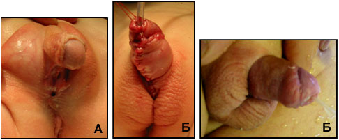 Отеки гипоспадия после операции
