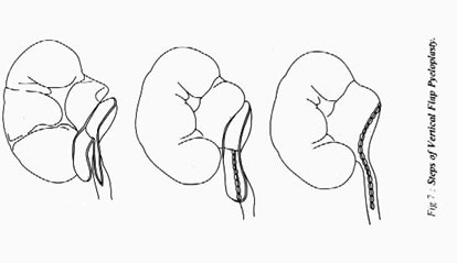 Этапы пластики лоханочномочеточникового сегмента вертикальным лоскутом лоханки
